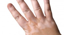 vitiligo.jpg - kopie